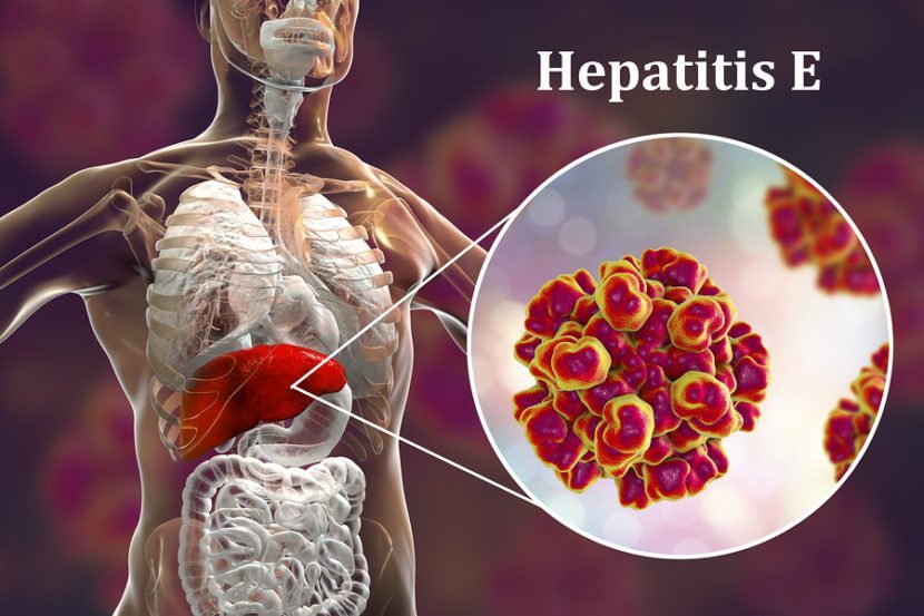 hepatitis e