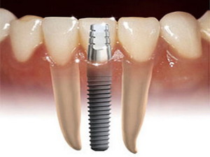 zubni_implanti_V