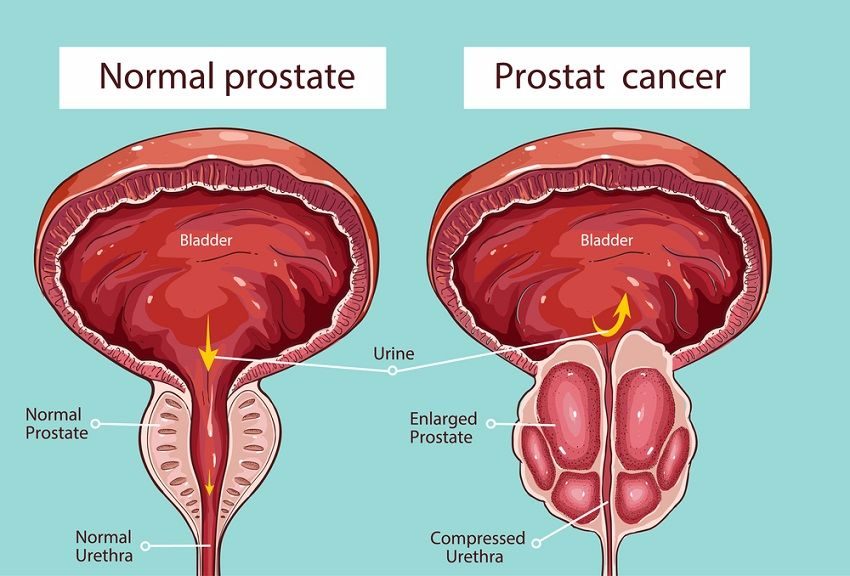 Prostata