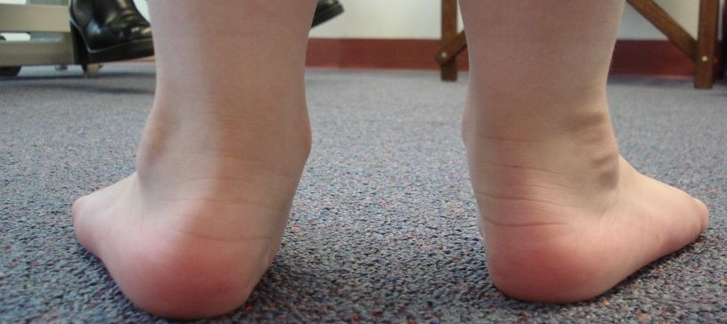 Spuštena stopala: Koji su uzroci i kojim vježbama popraviti stanje? (video) | forreststanley.com