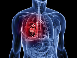 rak-pluća