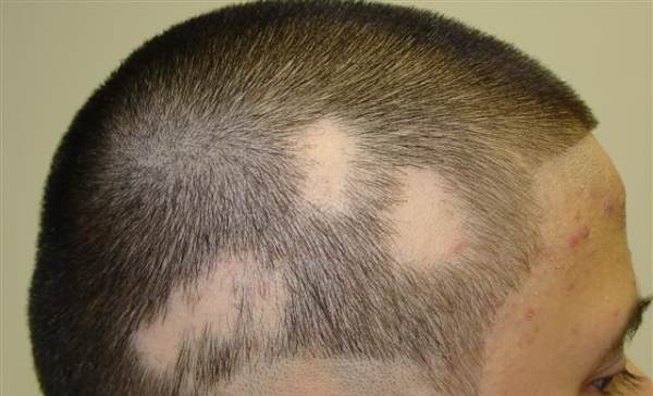 alopecija-opadanje-kose-u-krugovima