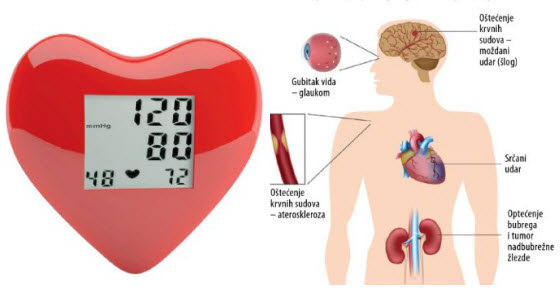 Arterijska hipertenzija - povišen krvni pritisak
