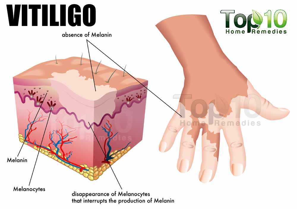 vitiligo 1000