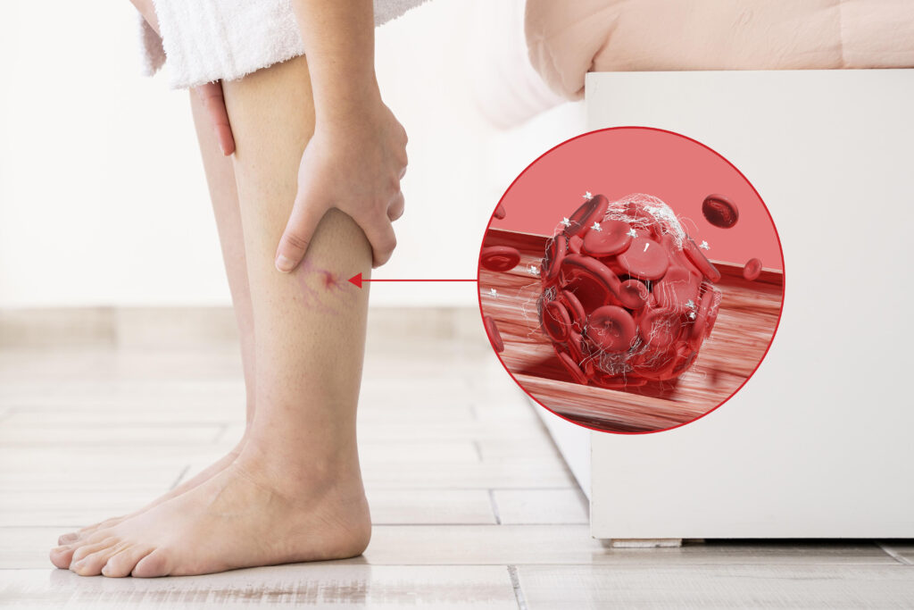 blood clots legs disease