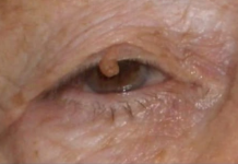 PAPILOMI I BRADAVICE NESTAJU KAO RUKOM ODNEŠENI: Samo koristite OVO, riješite ih se POTPUNO PRIRODNO