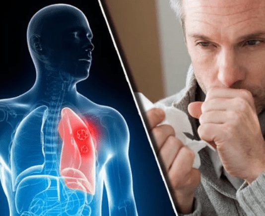 Nikad više nećete dobiti bronhitis i kašalj: Prirodni lek za decu i odrasle Nikad više nećete dobiti bronhitis i kašalj: Prirodni lek za decu i odrasle - featured image