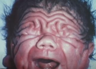 Na rođenju je izgledao kao Šar pej, ni lekari nisu mogli da objasne kako je to moguće: Ljudi tek ostanu u čudu kad vide kako izgleda 30 godina kasnije Na rođenju je izgledao kao Šar pej, ni lekari nisu mogli da objasne kako je to moguće: Ljudi tek ostanu u čudu kad vide kako izgleda 30 godina kasnije - featured image