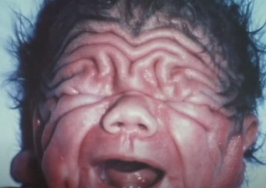 Na rođenju je izgledao kao Šar pej, ni lekari nisu mogli da objasne kako je to moguće: Ljudi tek ostanu u čudu kad vide kako izgleda 30 godina kasnije Na rođenju je izgledao kao Šar pej, ni lekari nisu mogli da objasne kako je to moguće: Ljudi tek ostanu u čudu kad vide kako izgleda 30 godina kasnije - featured image